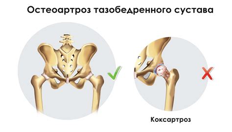 Связь между коксартрозом тазобедренного сустава и болевыми ощущениями в колене